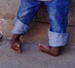 CURE_clubfoot.jpg